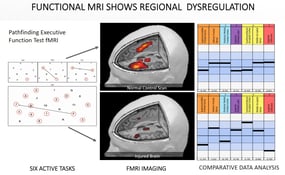 fMRI of injured brain from concussion
