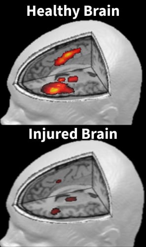 Functional MRI comparison: healthy brain activation pattern next to a post-concussion patient's activation pattern