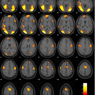 Concussion Victim fMRI