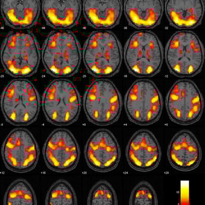 fMRI After EPIC Treatment