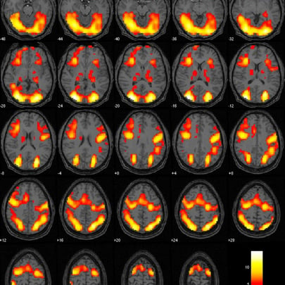fMRI After EPIC Treatment