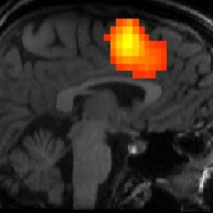concussion brain hyper activation