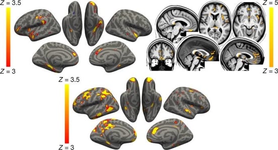 Mild COVID Linked to Brain Damage What That Means for You 2