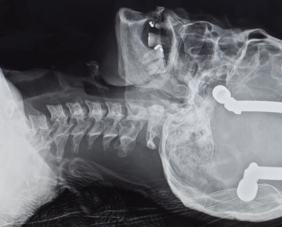 Example x-ray of upper spine and skull