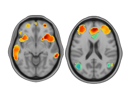Pre and Post Tx Brains TMS-04-03