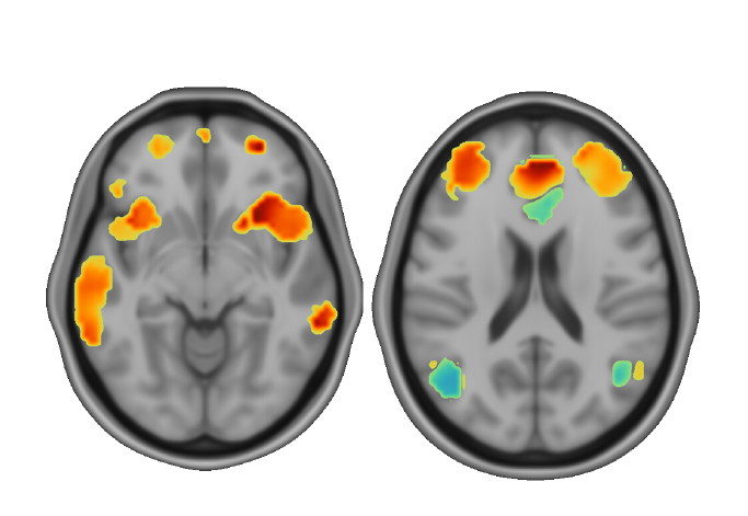 Pre and Post Tx Brains TMS-04-03