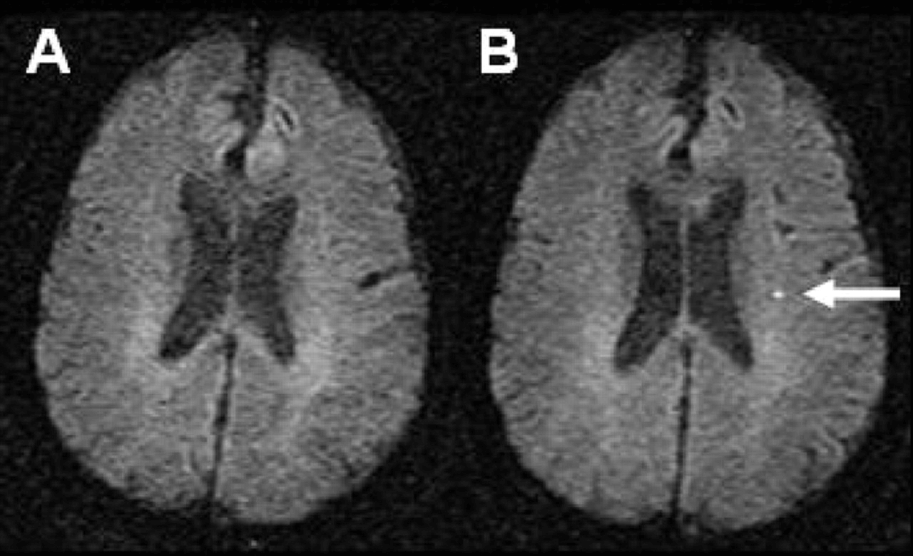 n this figure, we see a patient before (A) and after (B) a TIA caused a small cluster of dead brain cells. 