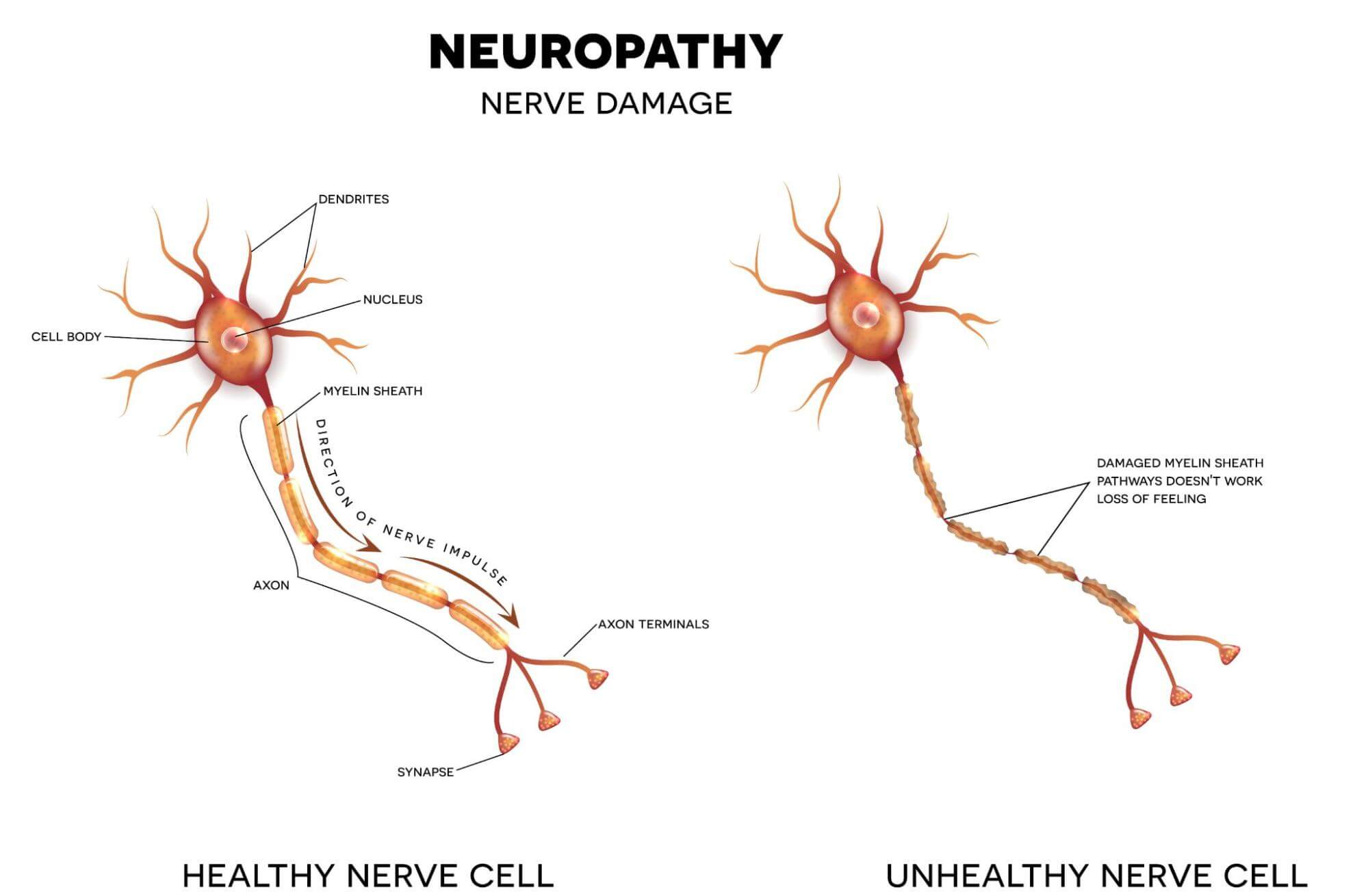 Image of a healthy nerve vs an unhealthy nerve