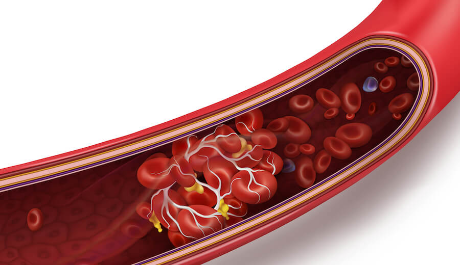 A graphic showing what a blood clot looks like in your veins.