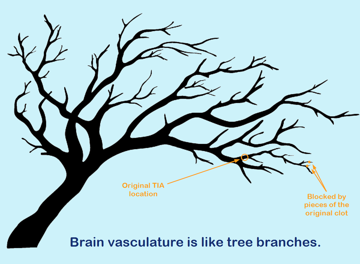 The After Effects Of Transient Ischemic Attack Cognitive Fx