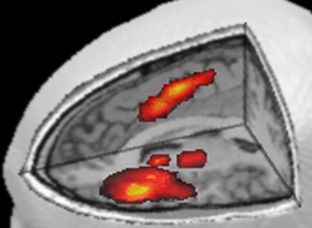 fMRI scan of a healthy brain showing large bright areas of activity