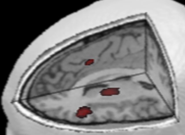 fMRI scan of a concussed brain showing only small faint areas of activity