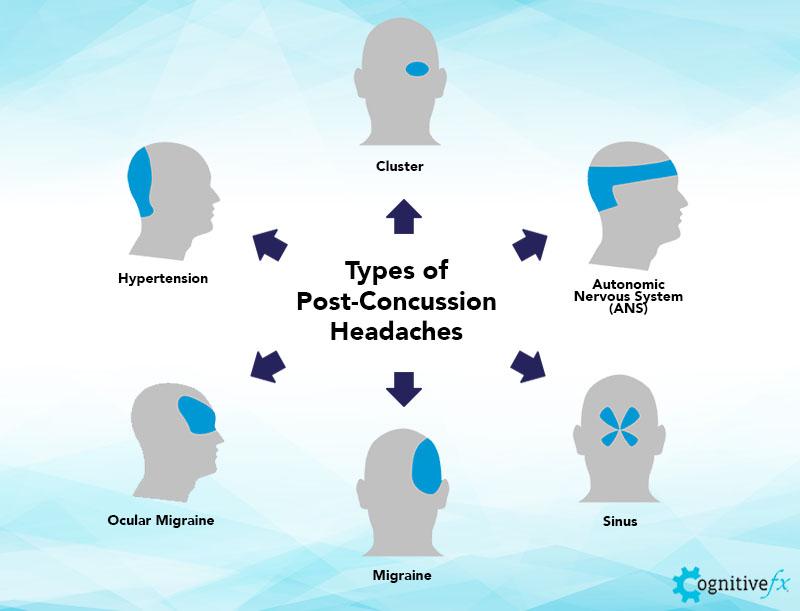 These are the most common post-concussion headaches reported by our patients.