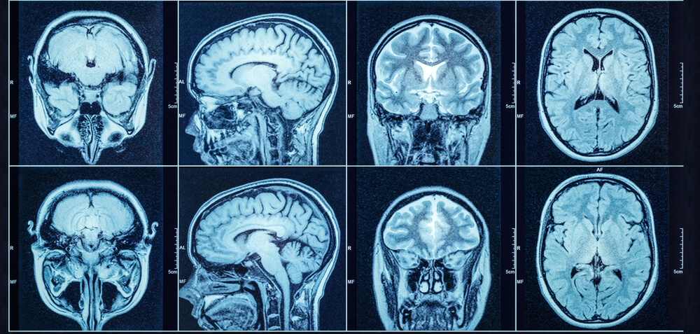 Brain scan results. 