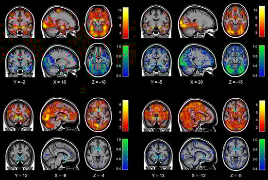 do-ct-scans-show-concussions-and-pcs-6