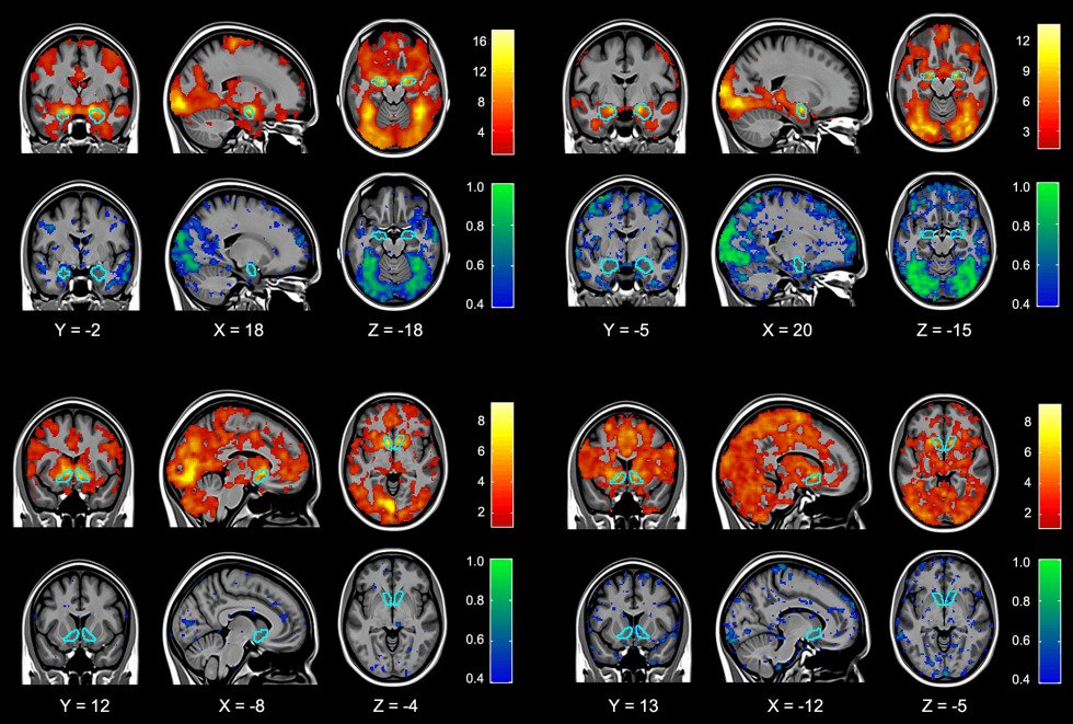 Concussion Ct Algorithm Do CT Scans Show Concussions or Post-Concussion Syndrome?