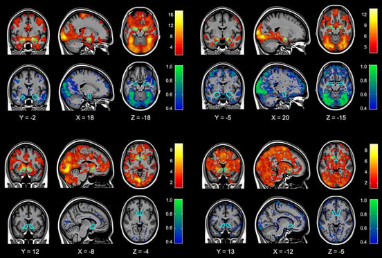 do-ct-scans-show-concussions-and-pcs-6