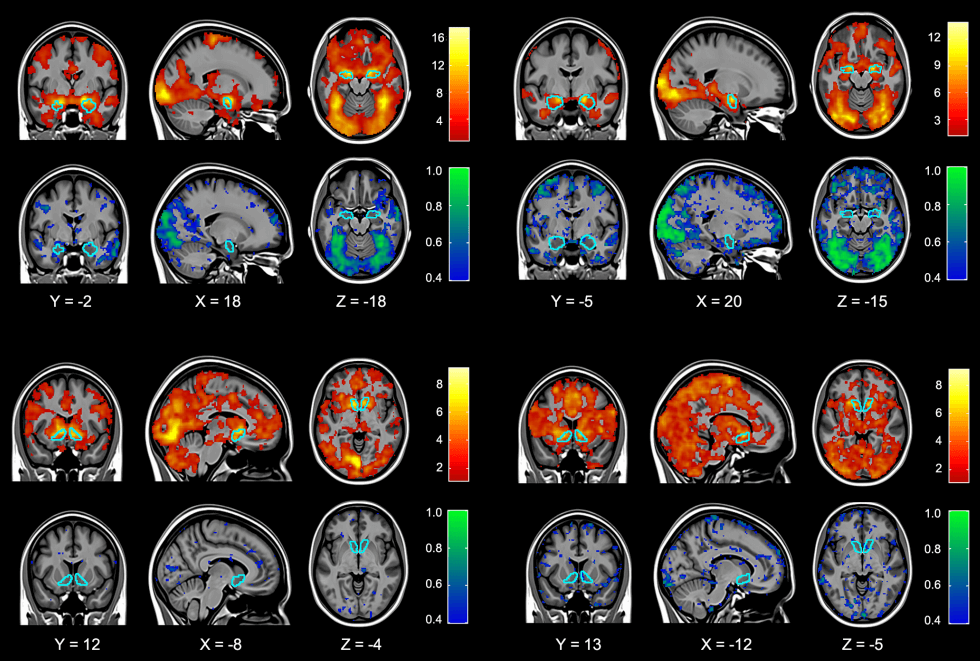 An example of an fMRI