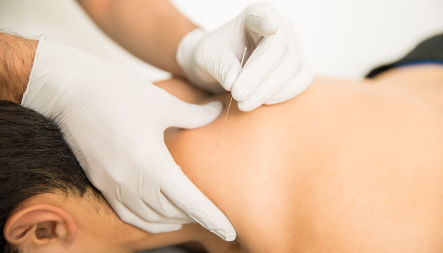 Dry needling and acupuncture for concussion can relieve certain symptoms.
