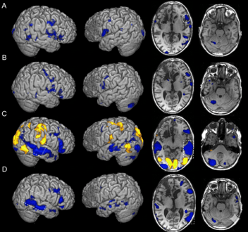 MRI-Guided TMS for Depression: A New Approach to Personalized Treatment