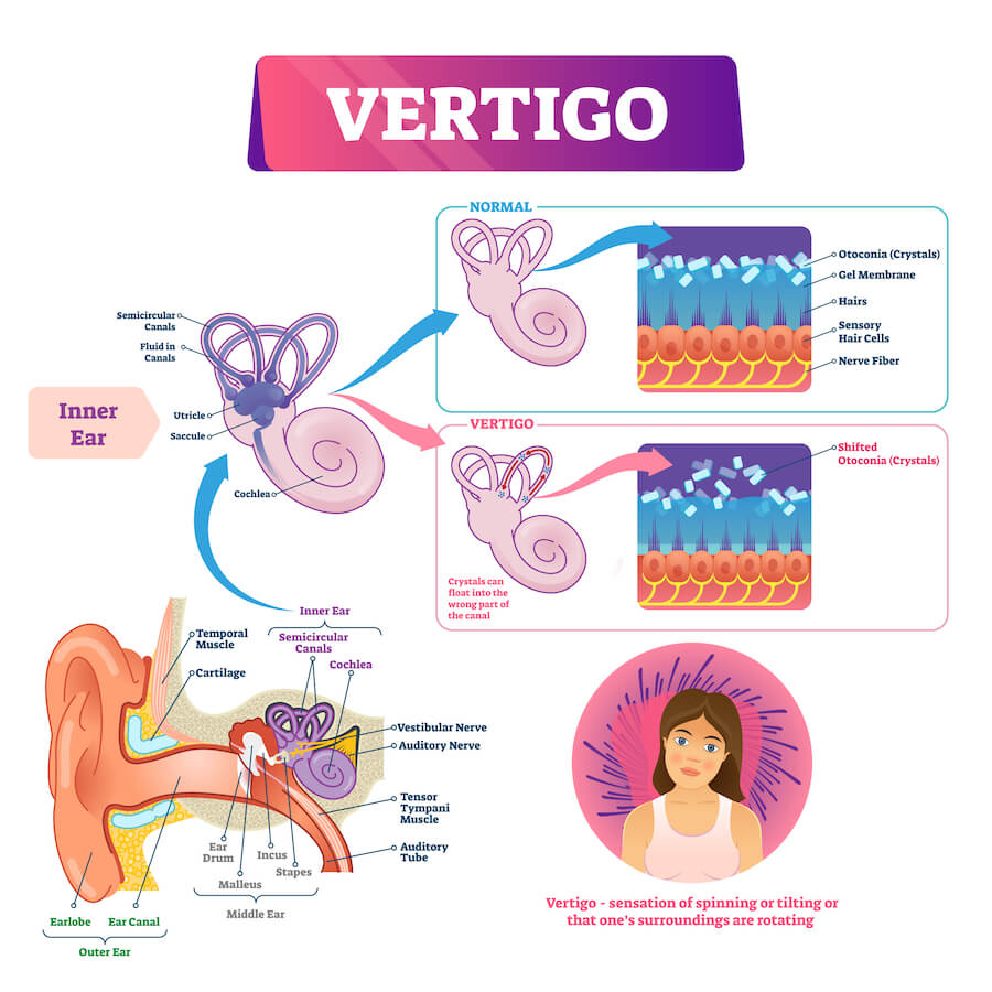 A vertigo explanation chart: normal vs vertigo. Vertigo is the sensation of spinning or tilting or that one's surroundings are rotating.