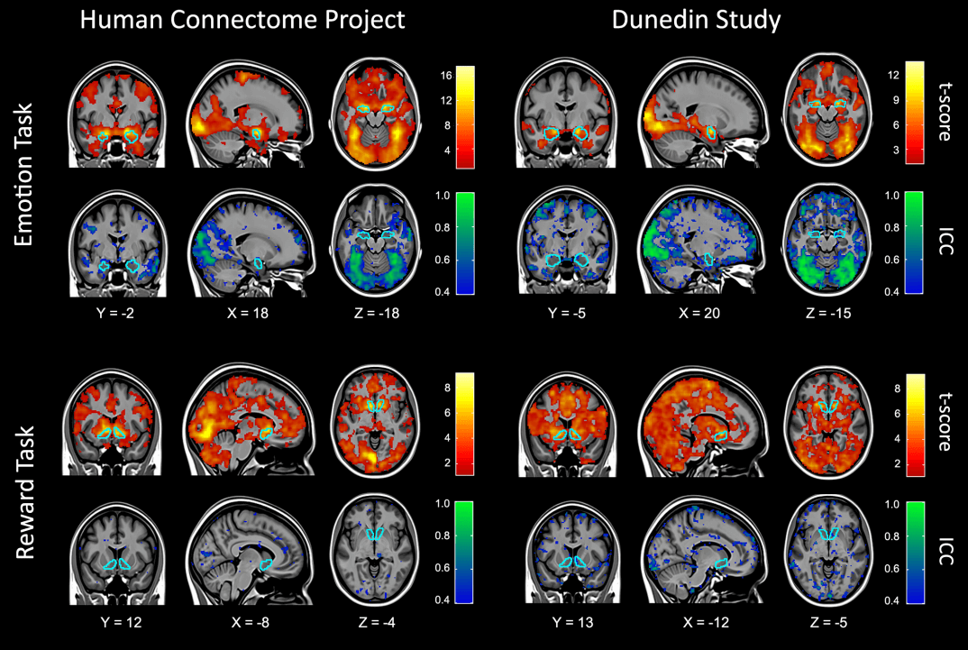 An fMRI scan example from the Duke Study