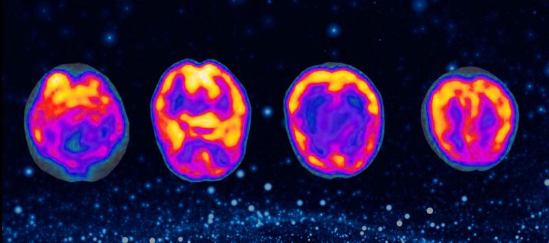 A SPECT scan for the brain shows an average over 10 - 15 min of scanning, but an fMRI can show each second of brain activity.