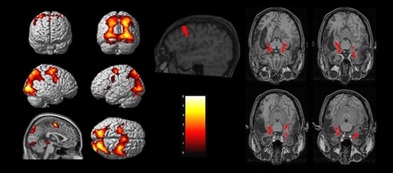 fmri-vs-spect-scan-for-brain-4
