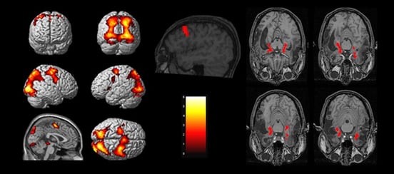 fMRI vs. SPECT Scan for the Brain