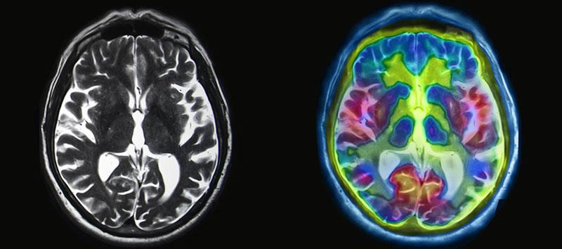 fMRI vs SPECT scans