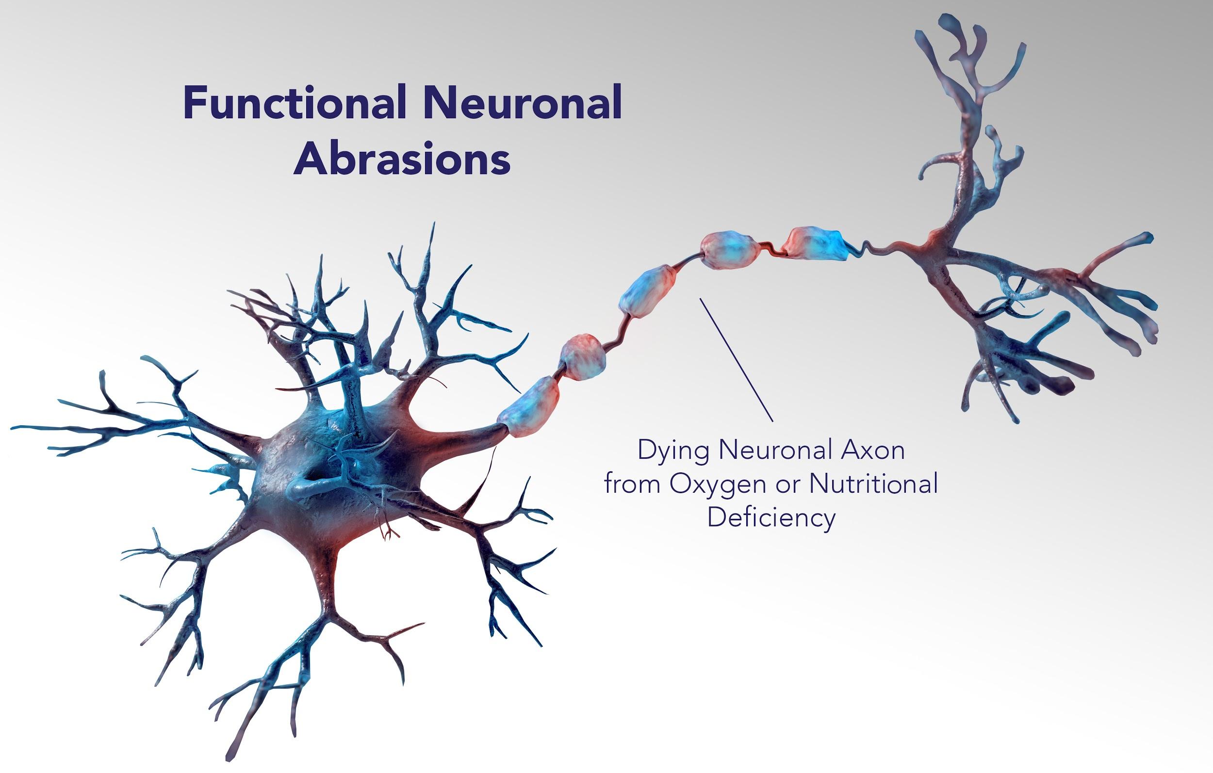 Functional Neuronal Abrasions: Dying Neuronal Axon from Oxygen or Nutritional Deficiency