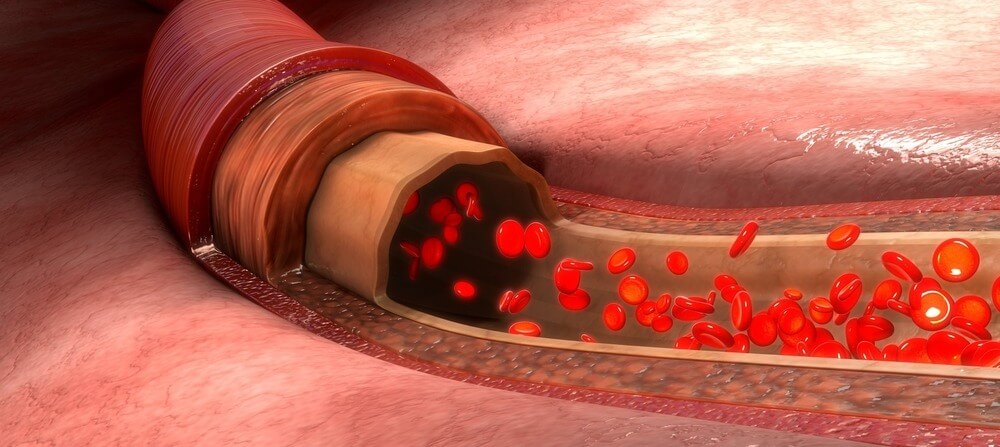 3D representation of a blood vessel.