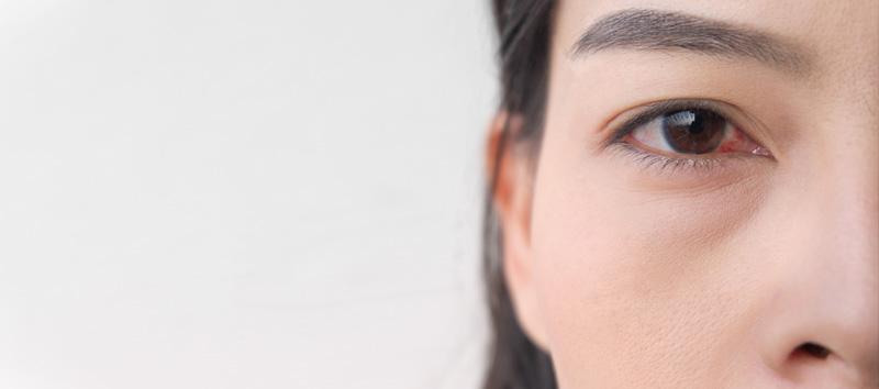 A photo of a woman with an eye condition.