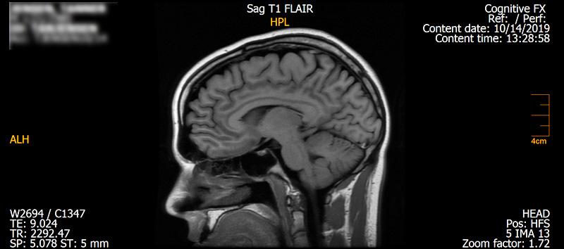 An example of an fMRI