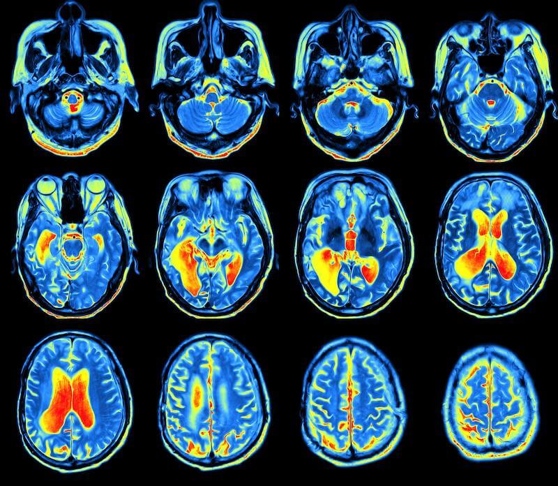 Long-term Multidomain Patterns of Change After Traumatic Brain Injury