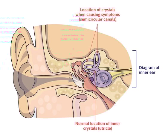 vestibular-therapy-for-concussion-symptoms-2