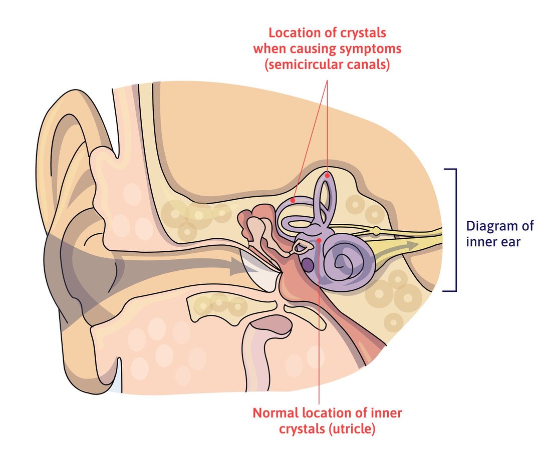 Vestibular Therapy for Concussion