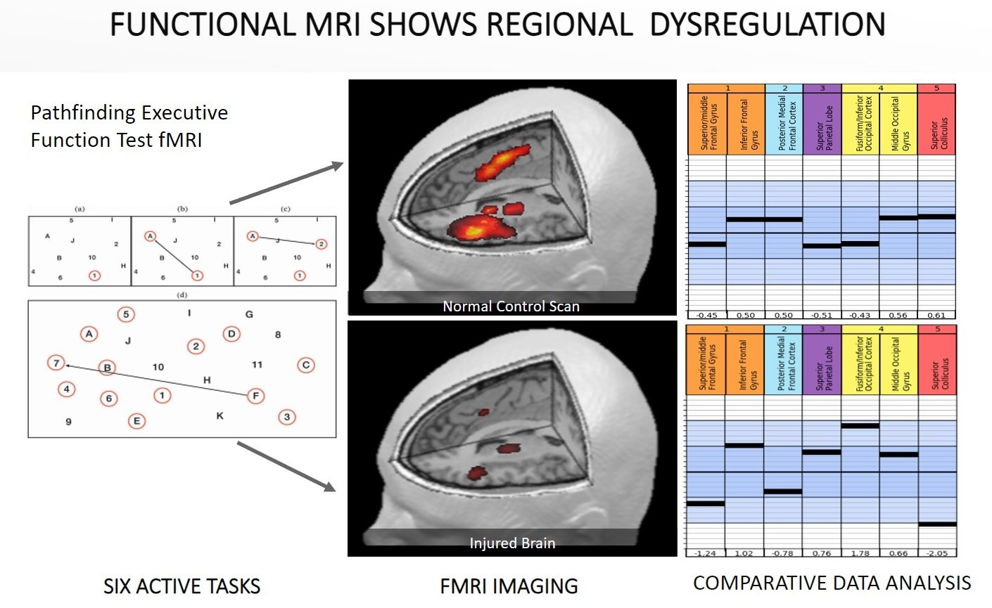 fMRI of injured brain from concussion