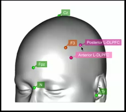 PMH Seminar Series - Target Location Image One D TMS 1D TMS