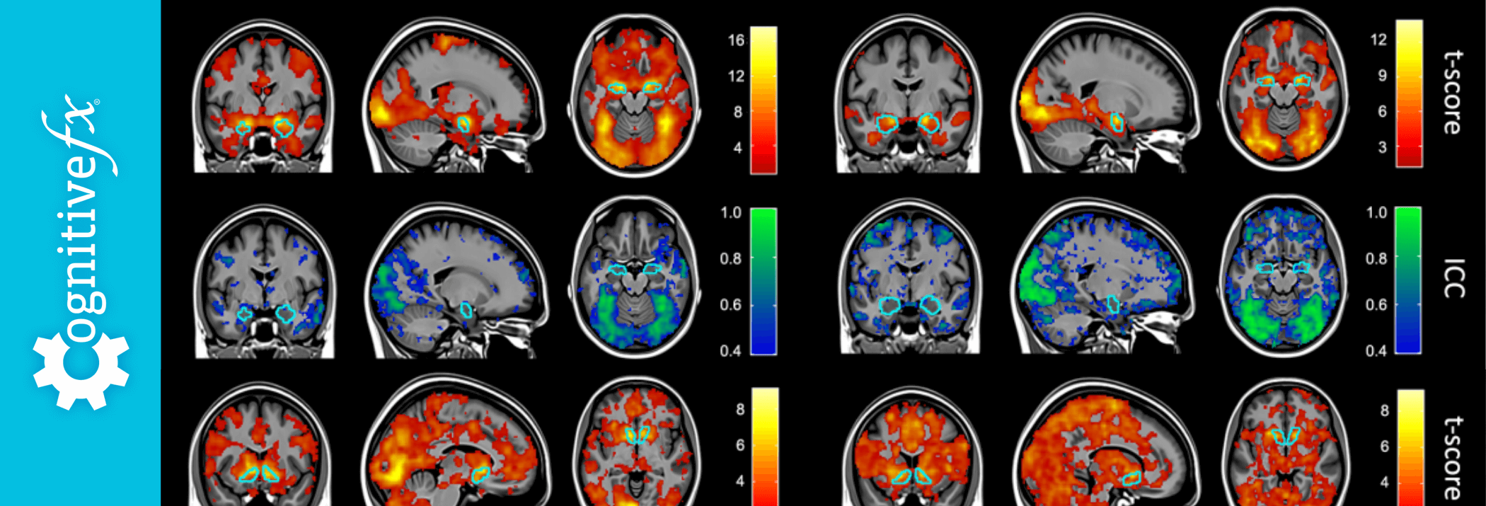 What the Duke Study on fMRI Brain Scans Means for Post-Concussion Syndrome Detection